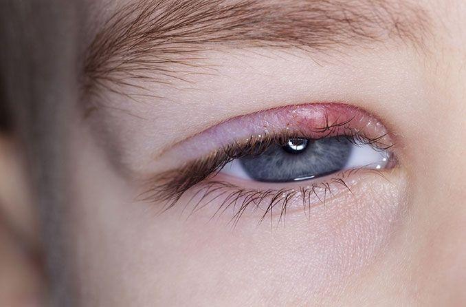 گل مژه چیست و درمان گل مژه به چه صورت است؟ گل مژه چیست؟